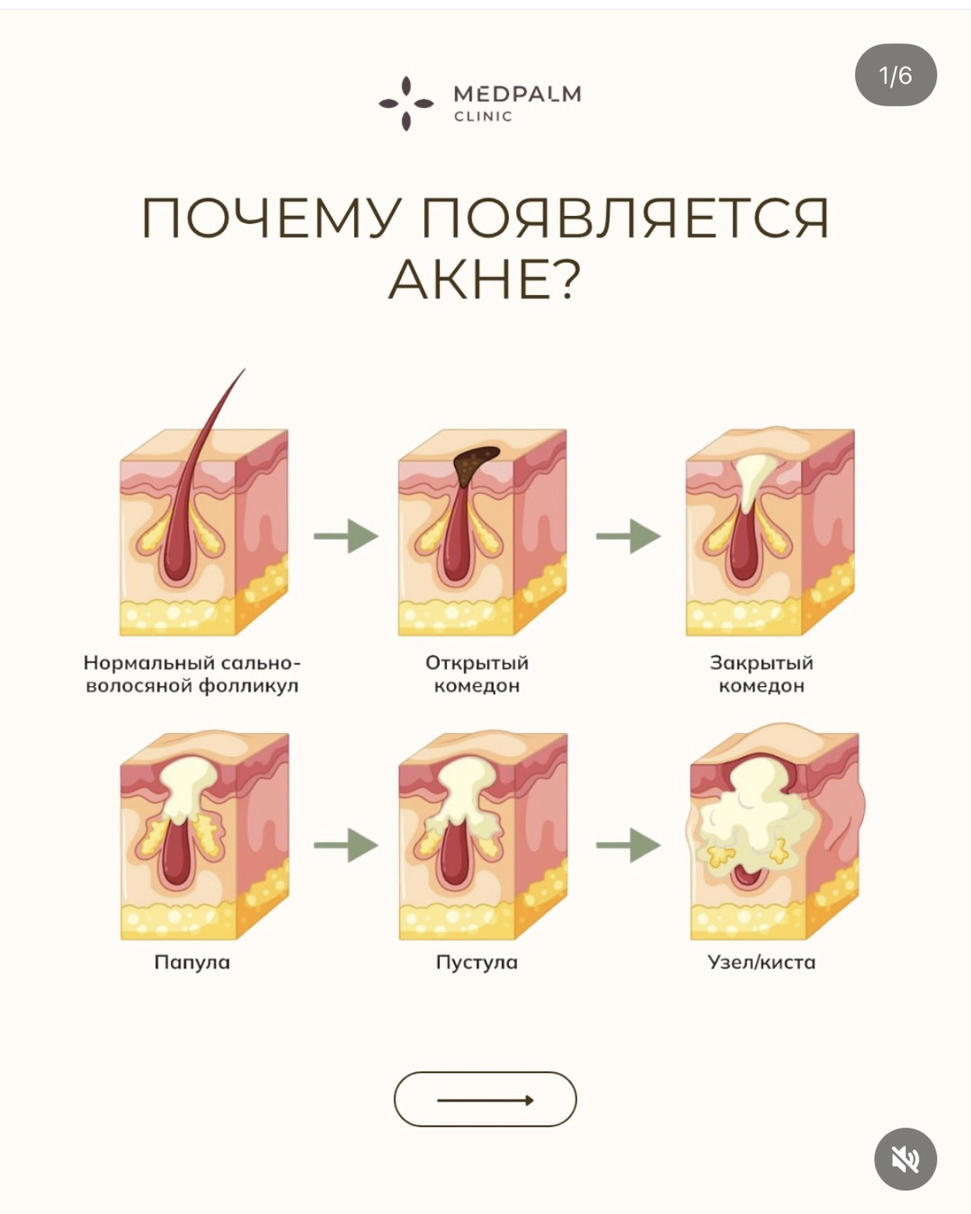 Карусель: почему появляется акне