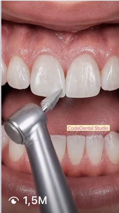 Code Dental — разбор процедуры — 1,5 млн просмотров