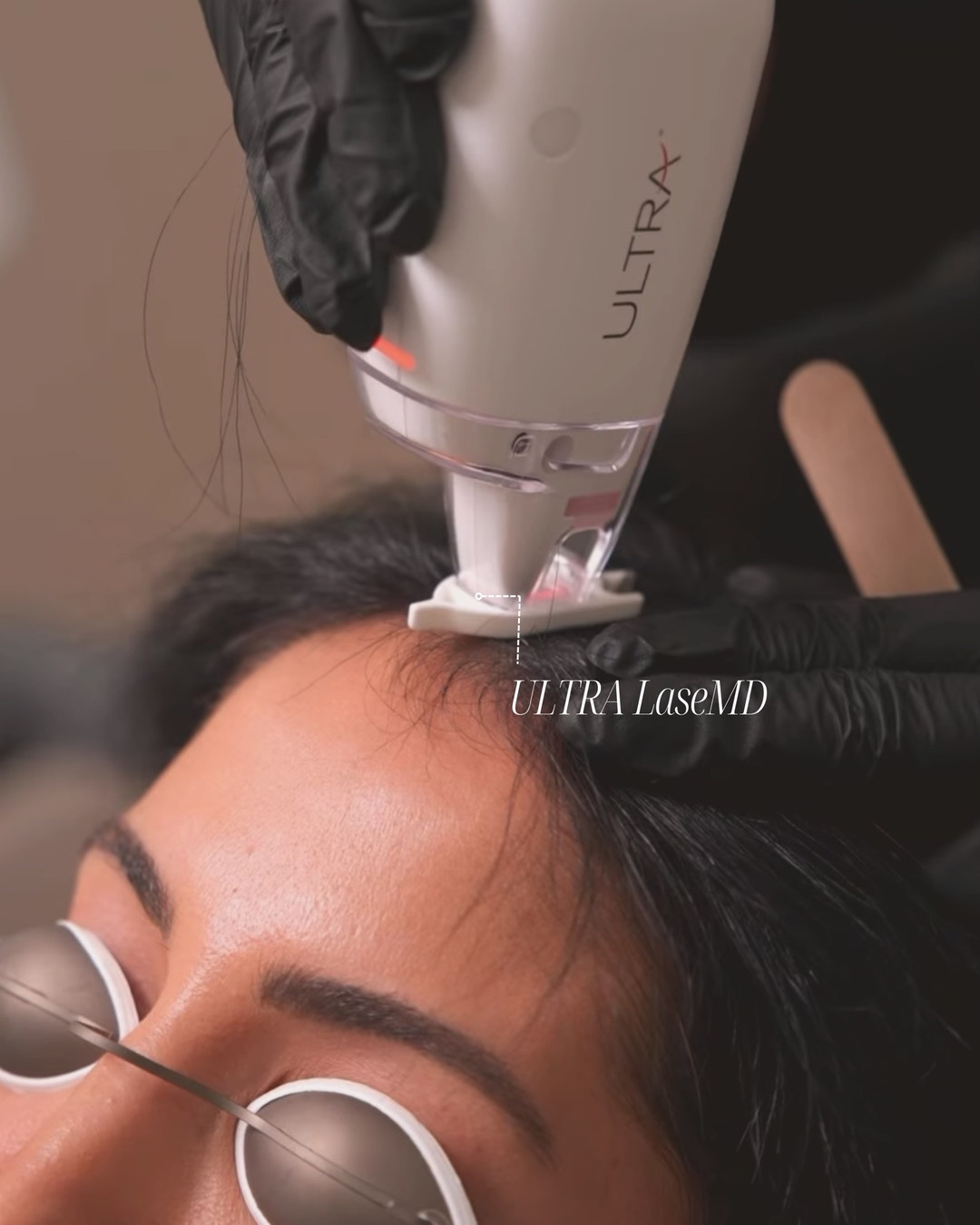 Rejuvie Med Spa — лазер ULTRA LaseMD